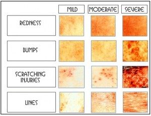 mild_medium_severe_eczema-300x231